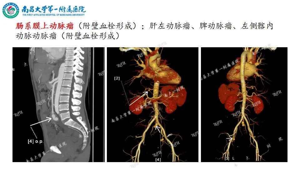 影像PPT - 【PPT】腹部血管性病变急腹症的影像诊断-21
