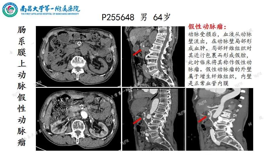 影像PPT - 【PPT】腹部血管性病变急腹症的影像诊断-25