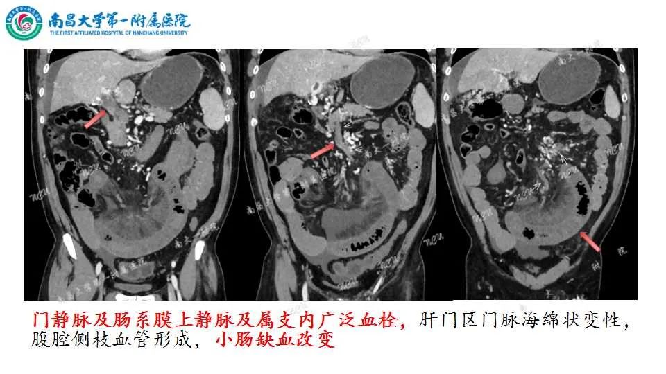 影像PPT - 【PPT】腹部血管性病变急腹症的影像诊断-28