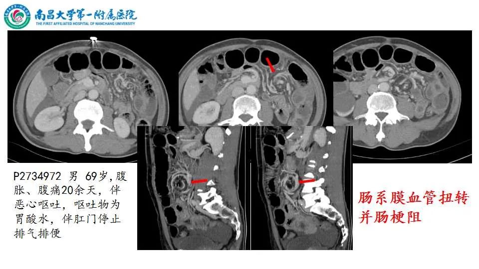 影像PPT - 【PPT】腹部血管性病变急腹症的影像诊断-29
