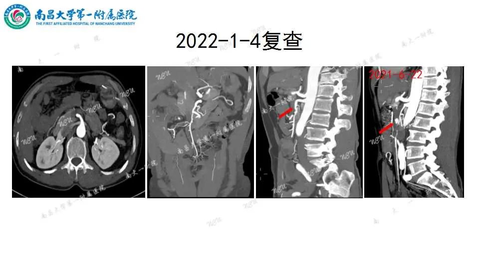 影像PPT - 【PPT】腹部血管性病变急腹症的影像诊断-24