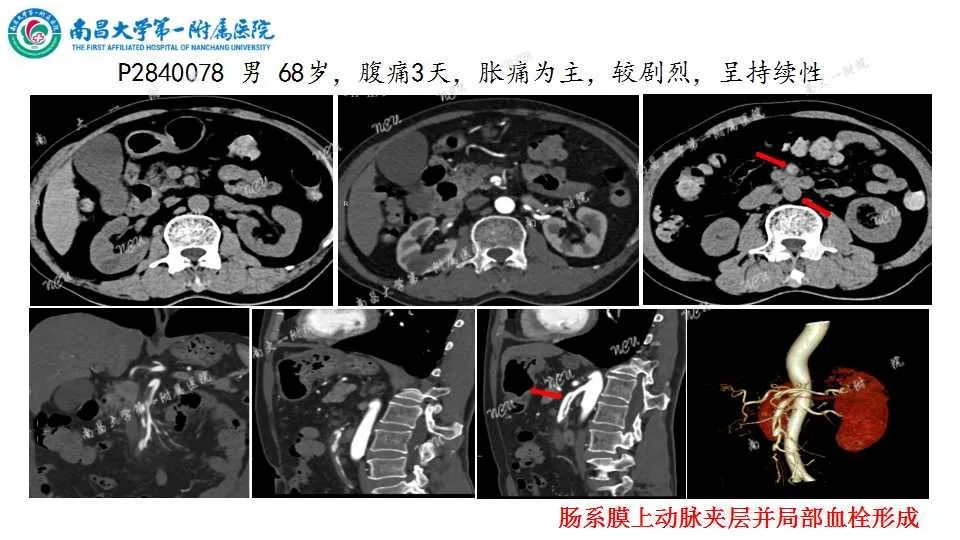 影像PPT - 【PPT】腹部血管性病变急腹症的影像诊断-26