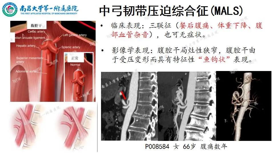 影像PPT - 【PPT】腹部血管性病变急腹症的影像诊断-31