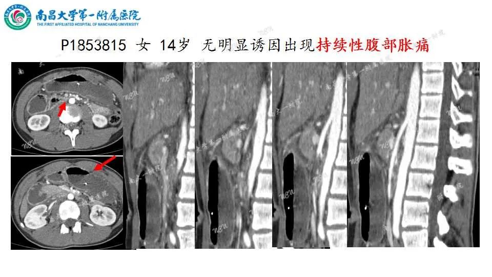 影像PPT - 【PPT】腹部血管性病变急腹症的影像诊断-37