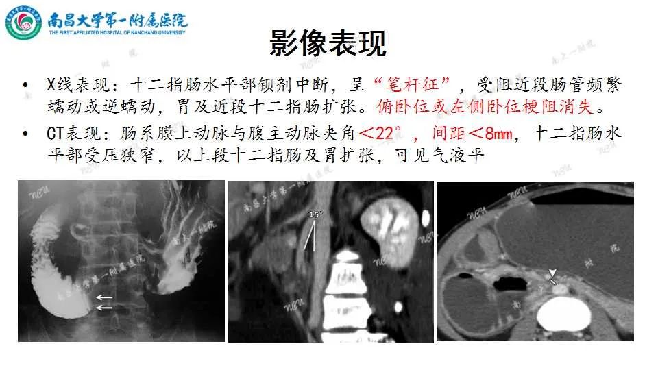 影像PPT - 【PPT】腹部血管性病变急腹症的影像诊断-36