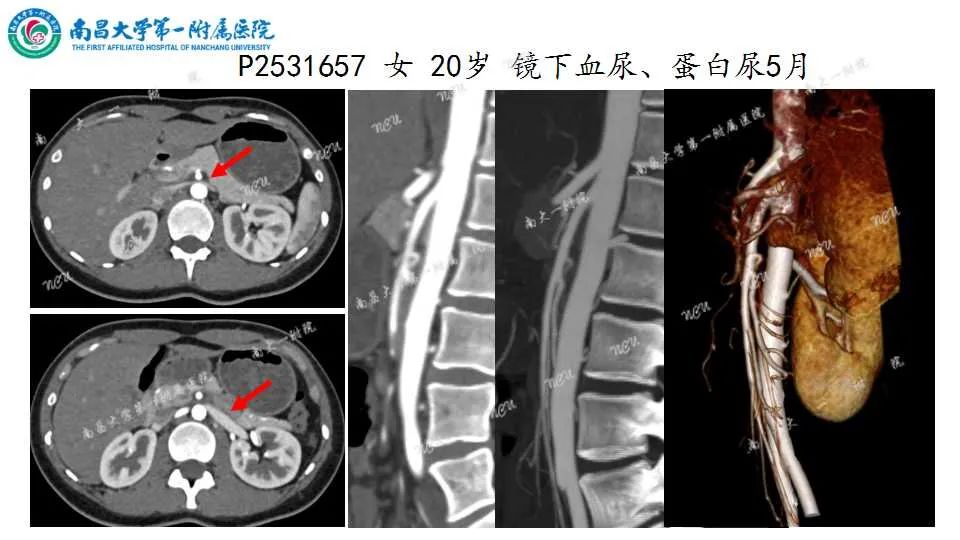 影像PPT - 【PPT】腹部血管性病变急腹症的影像诊断-40