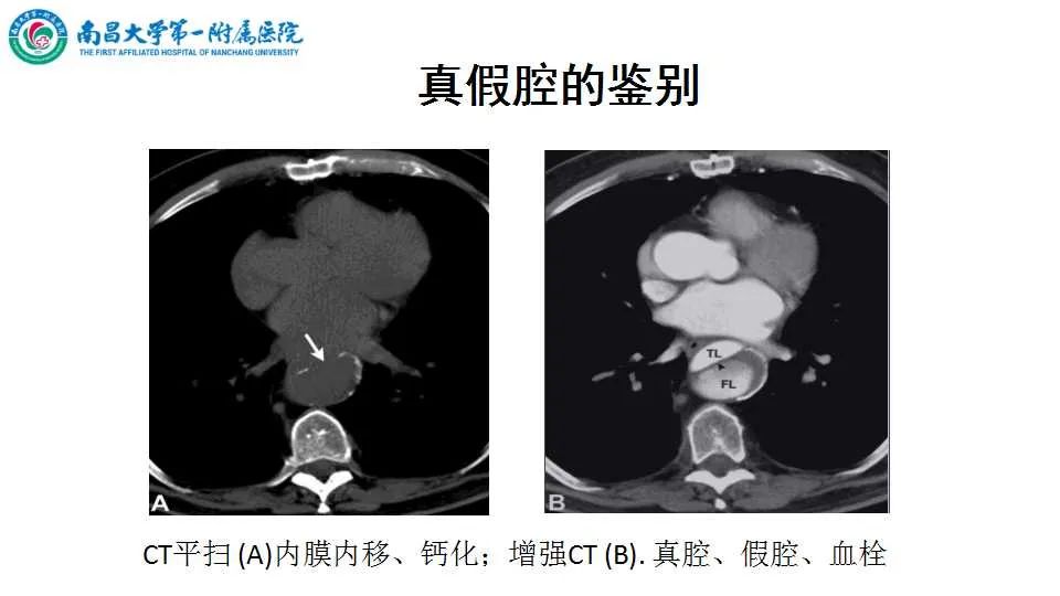 影像PPT - 【PPT】腹部血管性病变急腹症的影像诊断-46