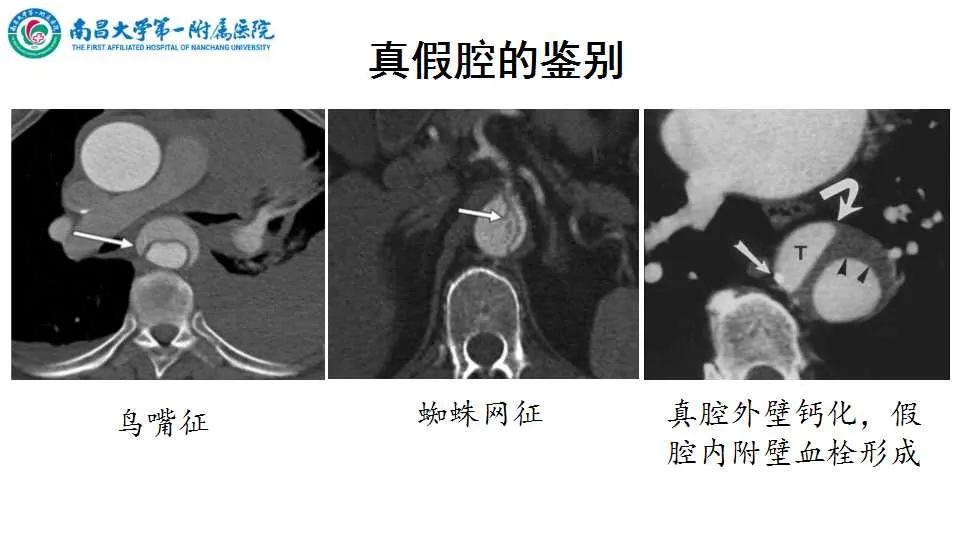 影像PPT - 【PPT】腹部血管性病变急腹症的影像诊断-47