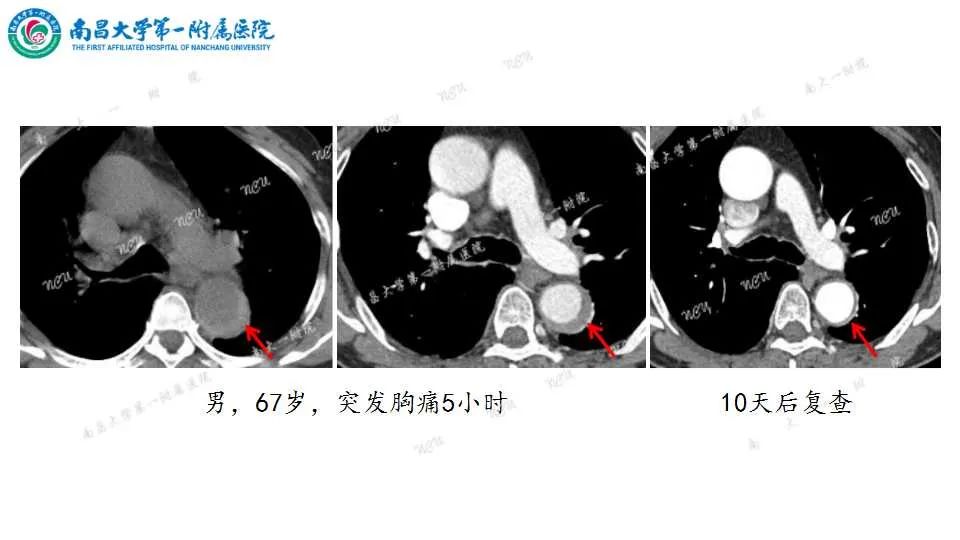影像PPT - 【PPT】腹部血管性病变急腹症的影像诊断-51