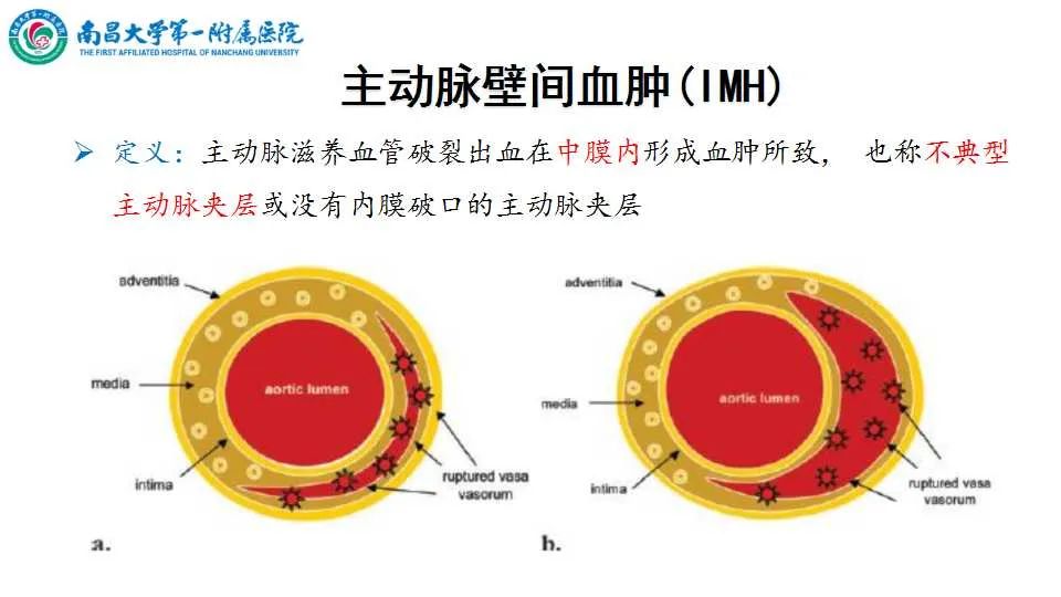 影像PPT - 【PPT】腹部血管性病变急腹症的影像诊断-48