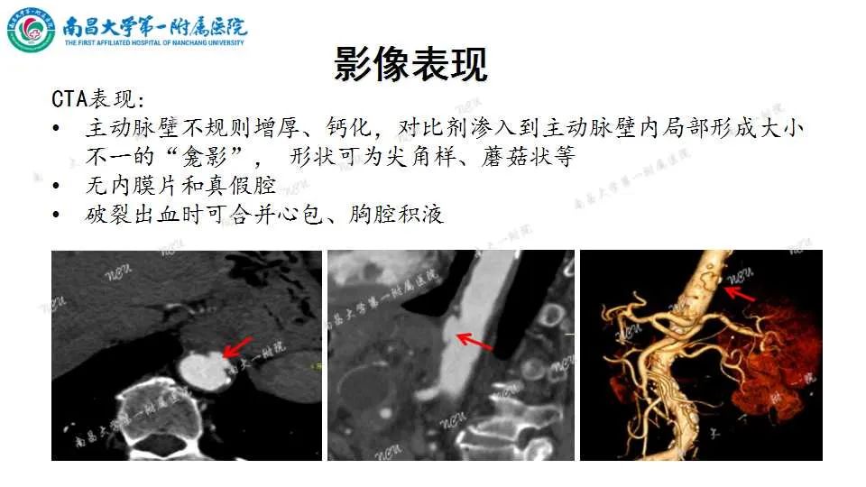 影像PPT - 【PPT】腹部血管性病变急腹症的影像诊断-54