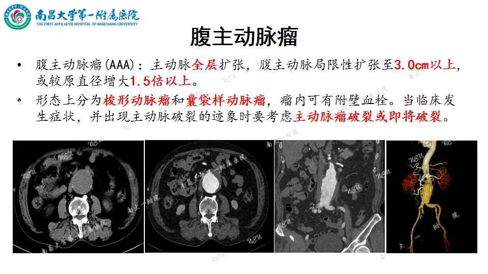 影像PPT - 【PPT】腹部血管性病变急腹症的影像诊断-56