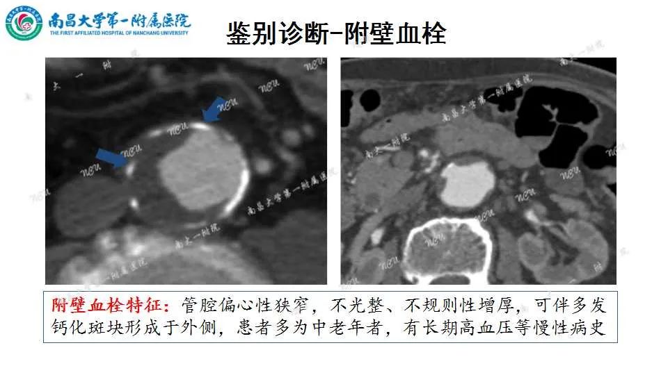 影像PPT - 【PPT】腹部血管性病变急腹症的影像诊断-52