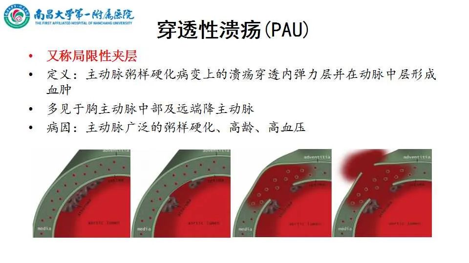 影像PPT - 【PPT】腹部血管性病变急腹症的影像诊断-53