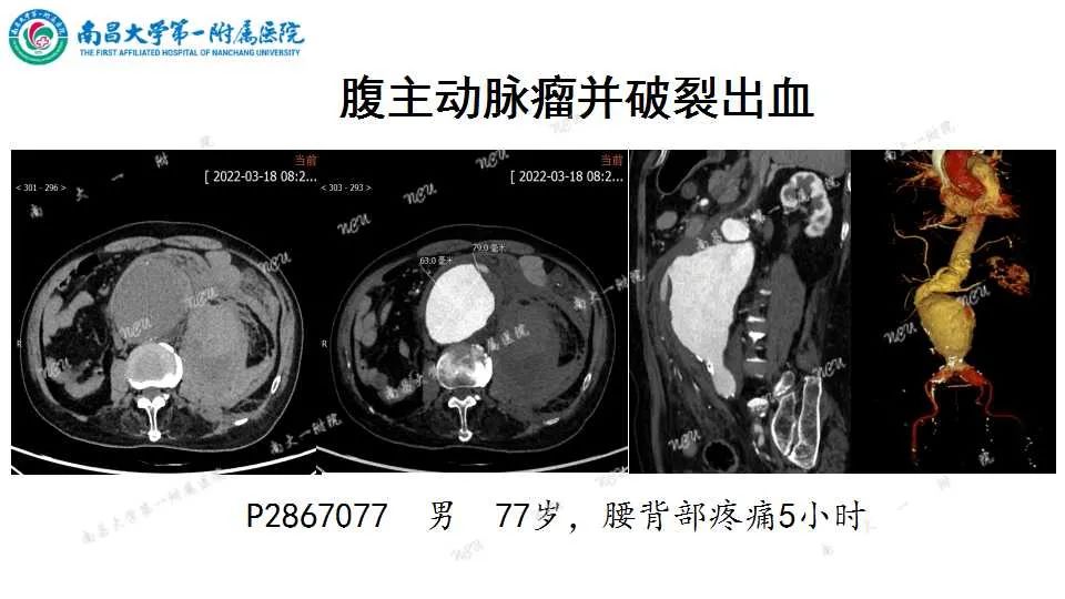 影像PPT - 【PPT】腹部血管性病变急腹症的影像诊断-57