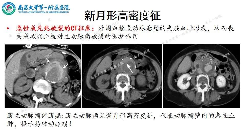 影像PPT - 【PPT】腹部血管性病变急腹症的影像诊断-59