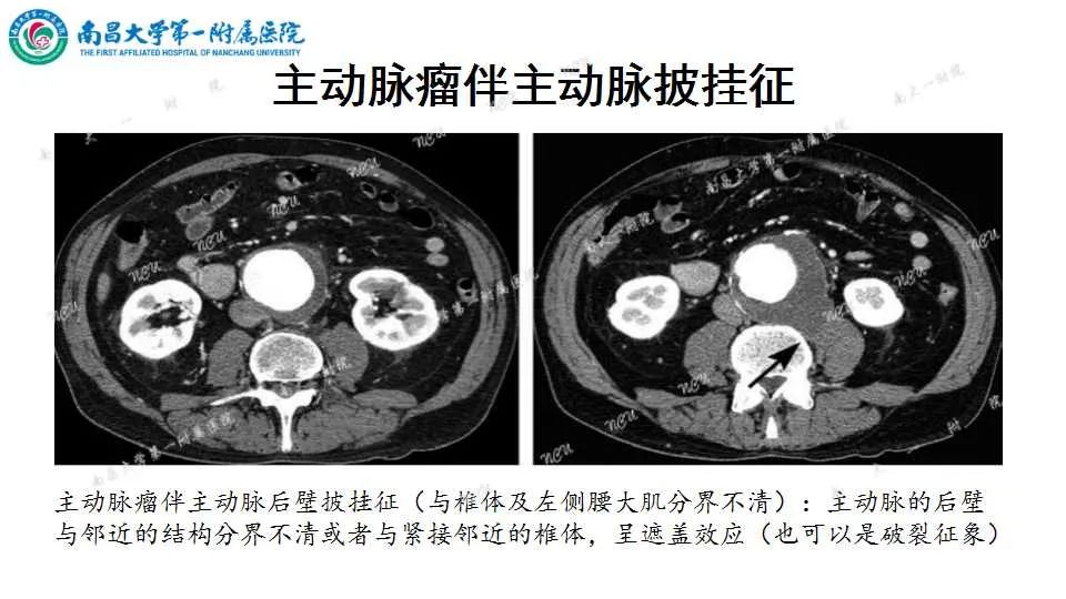 影像PPT - 【PPT】腹部血管性病变急腹症的影像诊断-60