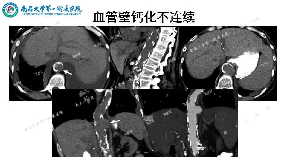 影像PPT - 【PPT】腹部血管性病变急腹症的影像诊断-61