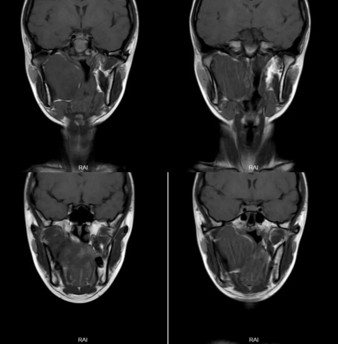 影像PPT - 【病例】咽旁间隙多形性腺瘤1例MR影像鉴别-4 影像PPT - 【病例】咽旁间隙多形性腺瘤1例MR影像鉴别-4