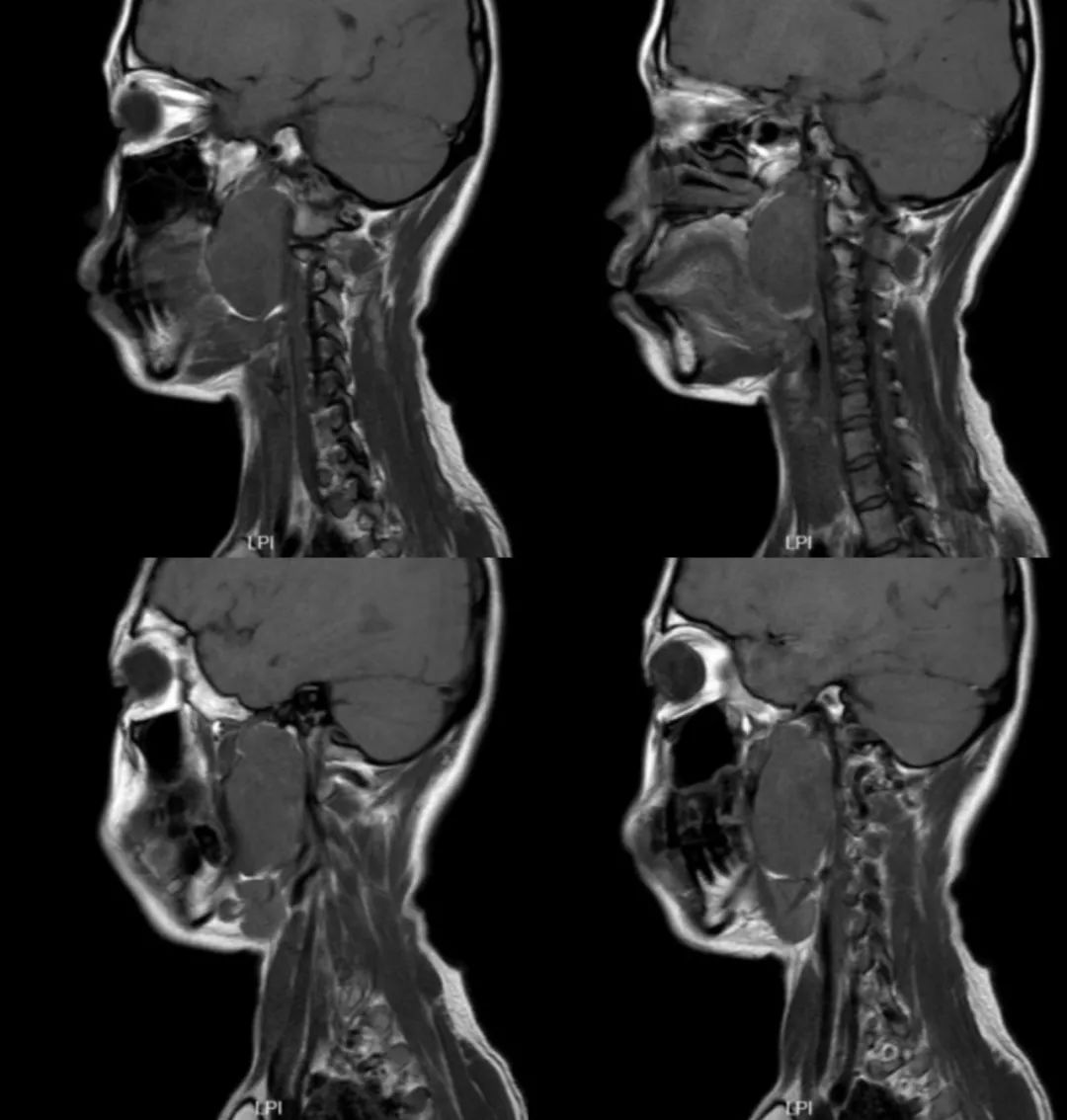 影像PPT - 【病例】咽旁间隙多形性腺瘤1例MR影像鉴别-5 影像PPT - 【病例】咽旁间隙多形性腺瘤1例MR影像鉴别-5