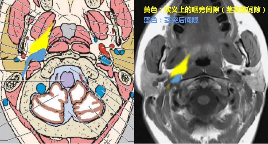 影像PPT - 【病例】咽旁间隙多形性腺瘤1例MR影像鉴别-10 影像PPT - 【病例】咽旁间隙多形性腺瘤1例MR影像鉴别-10