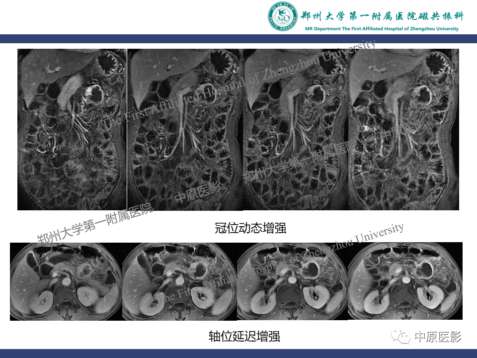 影像PPT - 【病例】小肠间质瘤1例MR影像-6