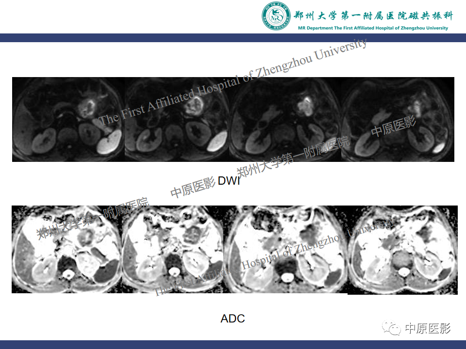 影像PPT - 【病例】小肠间质瘤1例MR影像-5