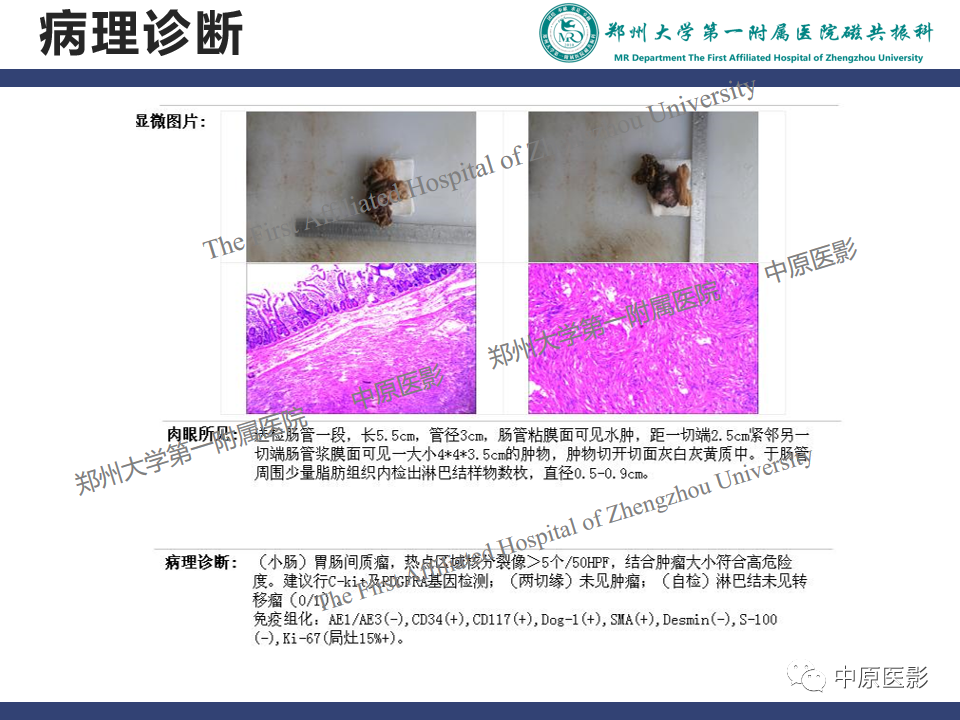 影像PPT - 【病例】小肠间质瘤1例MR影像-9