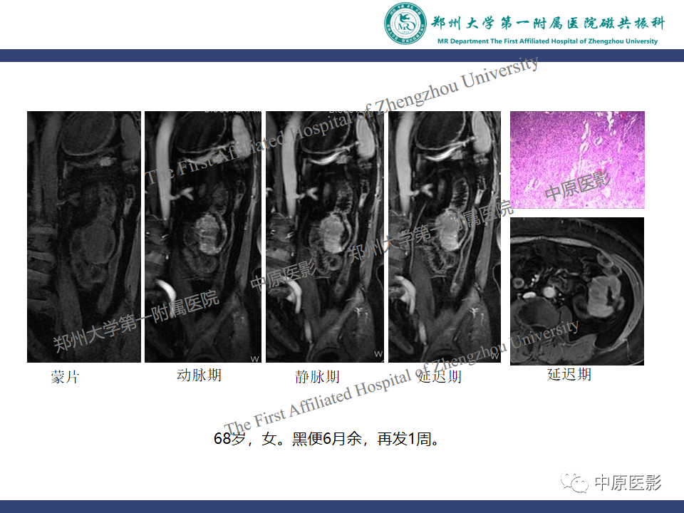 影像PPT - 【病例】小肠间质瘤1例MR影像-11