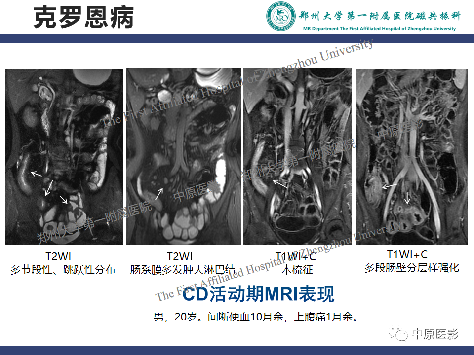 影像PPT - 【病例】小肠间质瘤1例MR影像-14