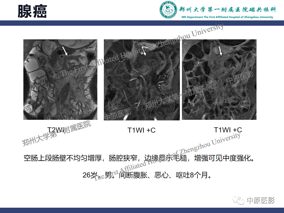 影像PPT - 【病例】小肠间质瘤1例MR影像-18