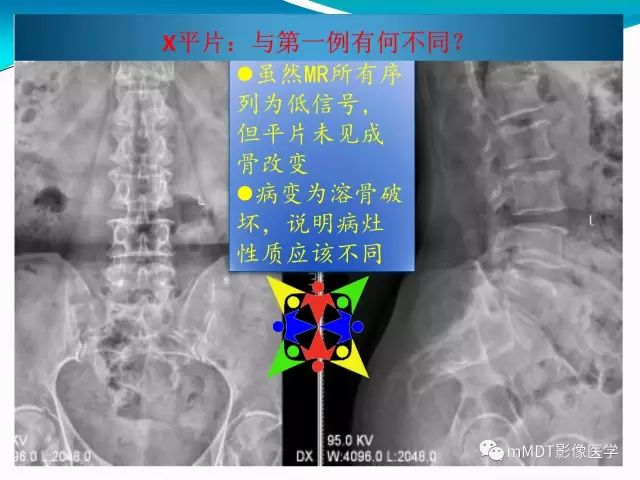 影像PPT - 【PPT】骶尾椎病变的诊断思路-10