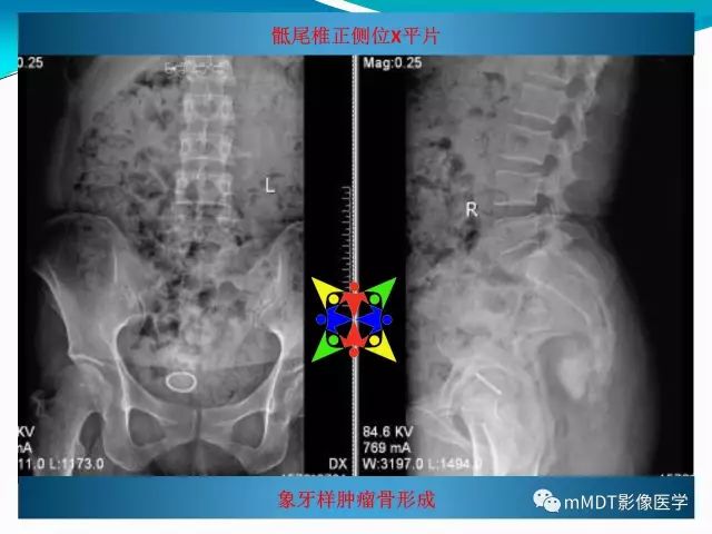影像PPT - 【PPT】骶尾椎病变的诊断思路-6