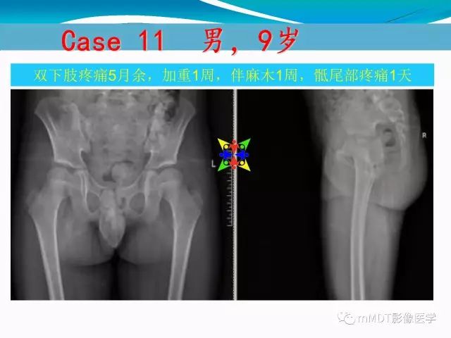 影像PPT - 【PPT】骶尾椎病变的诊断思路-44