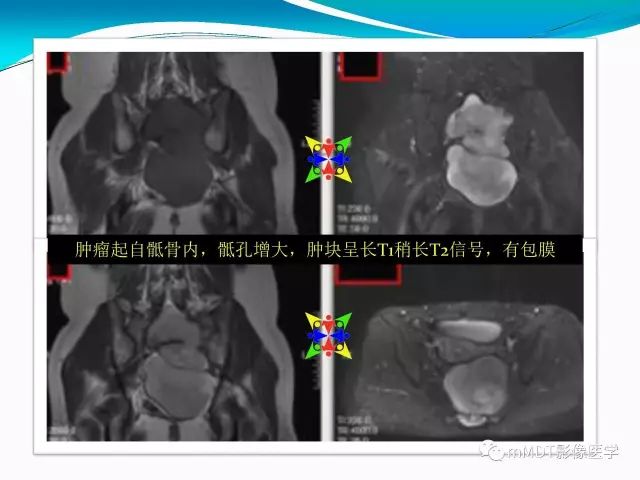 影像PPT - 【PPT】骶尾椎病变的诊断思路-63
