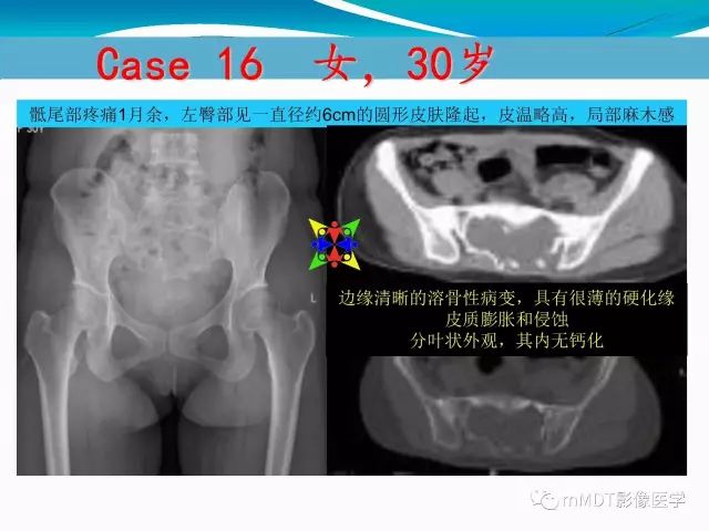 影像PPT - 【PPT】骶尾椎病变的诊断思路-62