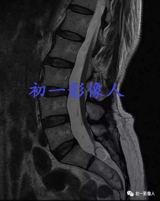 影像PPT - 骶管脂肪瘤-2 影像PPT - 骶管脂肪瘤-2