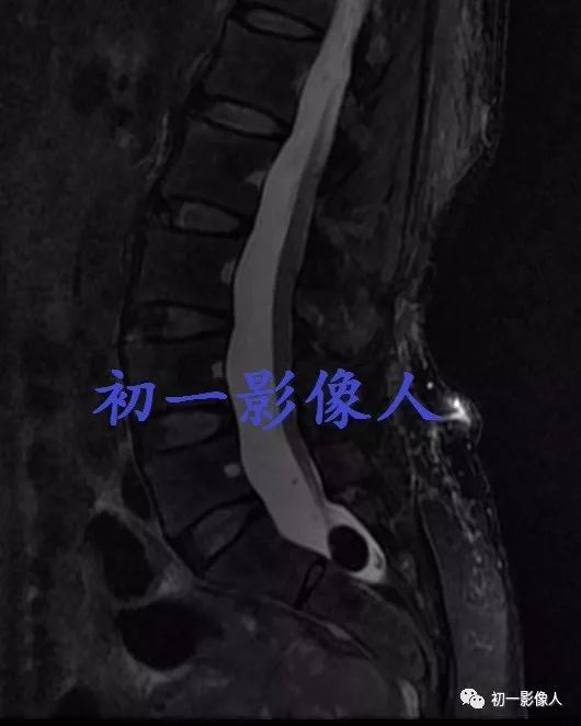 影像PPT - 骶管脂肪瘤-3 影像PPT - 骶管脂肪瘤-3