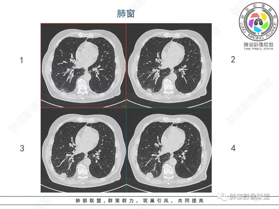 影像PPT - 【病例】胸膜下的“山丘”—肺大细胞神经内分泌癌1例CT-3 影像PPT - 【病例】胸膜下的“山丘”—肺大细胞神经内分泌癌1例CT-3