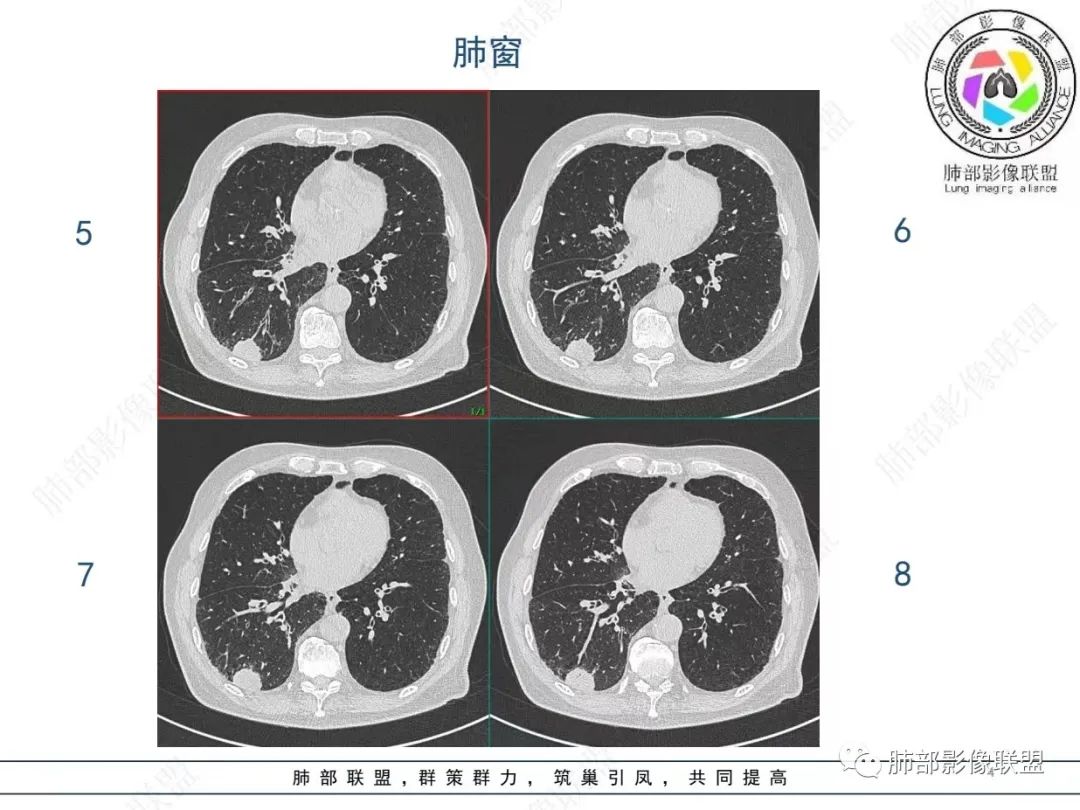 影像PPT - 【病例】胸膜下的“山丘”—肺大细胞神经内分泌癌1例CT-4 影像PPT - 【病例】胸膜下的“山丘”—肺大细胞神经内分泌癌1例CT-4