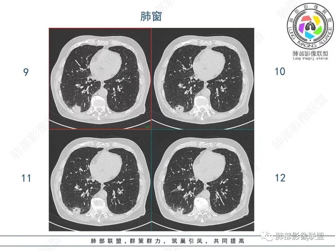 影像PPT - 【病例】胸膜下的“山丘”—肺大细胞神经内分泌癌1例CT-5 影像PPT - 【病例】胸膜下的“山丘”—肺大细胞神经内分泌癌1例CT-5