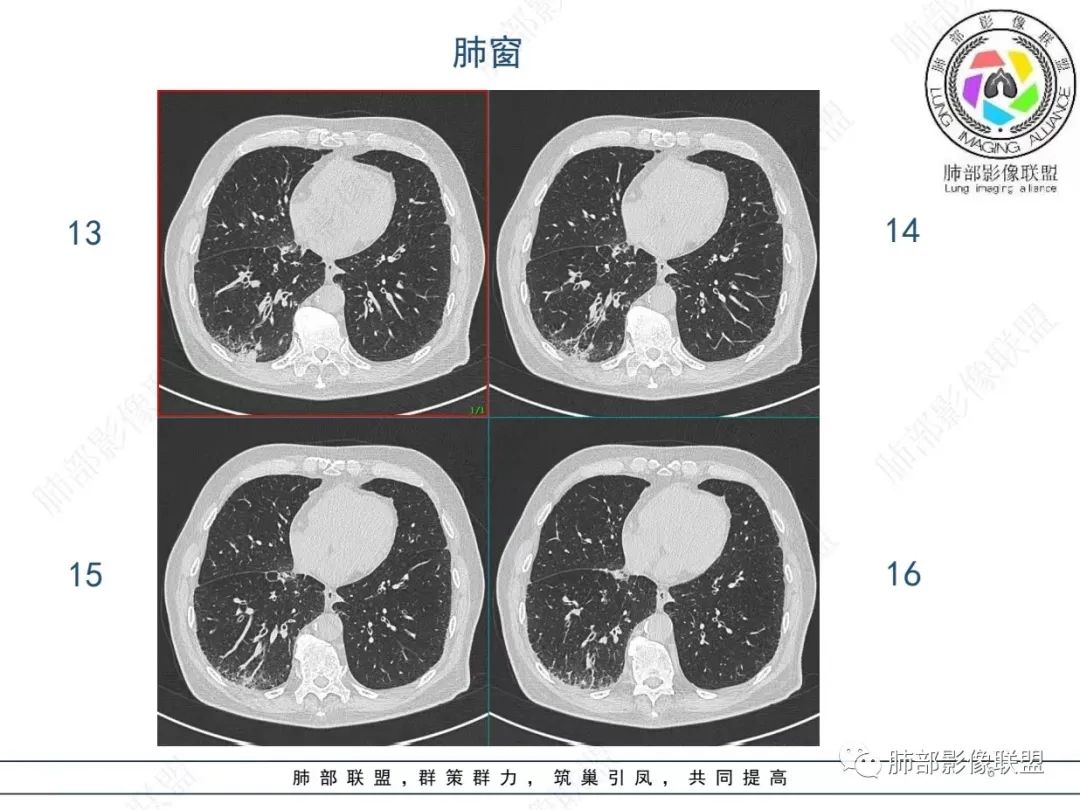 影像PPT - 【病例】胸膜下的“山丘”—肺大细胞神经内分泌癌1例CT-6 影像PPT - 【病例】胸膜下的“山丘”—肺大细胞神经内分泌癌1例CT-6