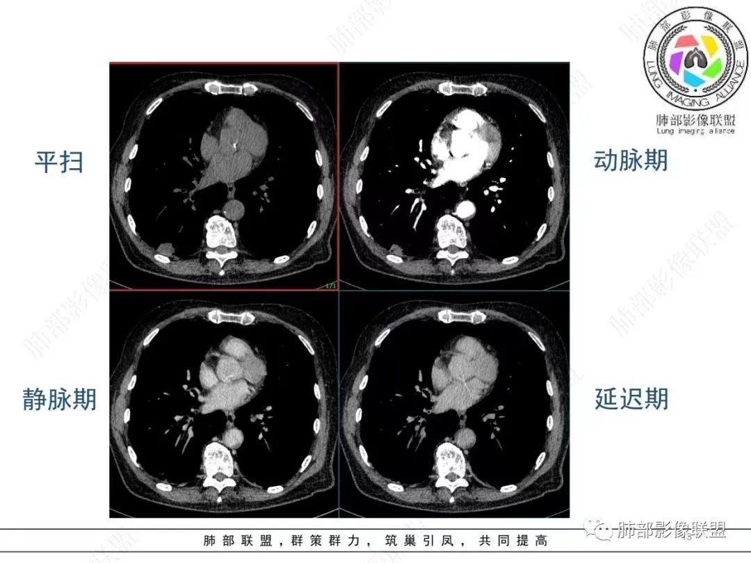 影像PPT - 【病例】胸膜下的“山丘”—肺大细胞神经内分泌癌1例CT-13 影像PPT - 【病例】胸膜下的“山丘”—肺大细胞神经内分泌癌1例CT-13