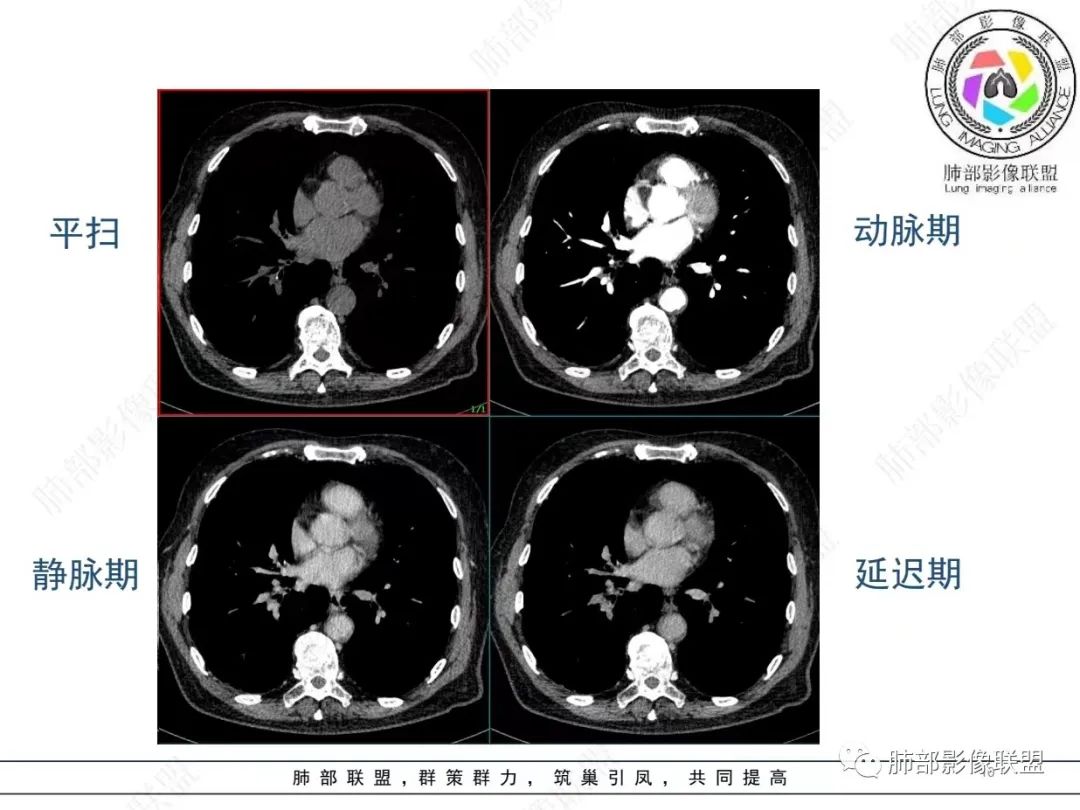 影像PPT - 【病例】胸膜下的“山丘”—肺大细胞神经内分泌癌1例CT-10 影像PPT - 【病例】胸膜下的“山丘”—肺大细胞神经内分泌癌1例CT-10