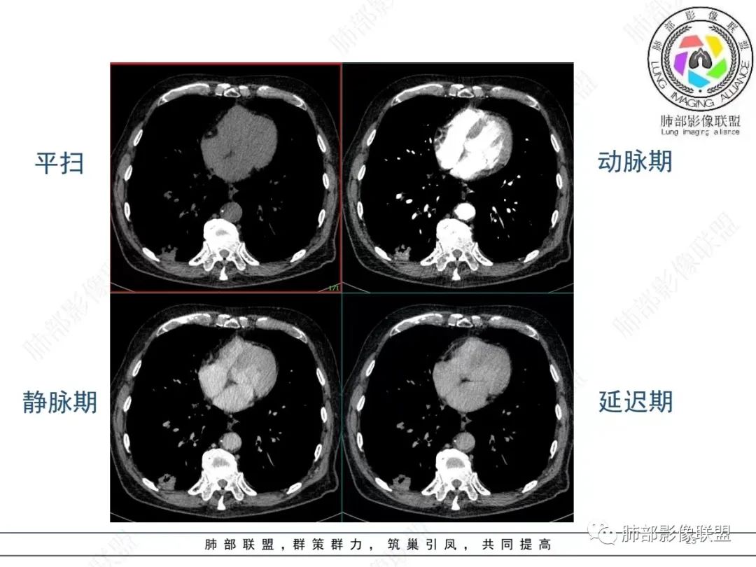 影像PPT - 【病例】胸膜下的“山丘”—肺大细胞神经内分泌癌1例CT-23 影像PPT - 【病例】胸膜下的“山丘”—肺大细胞神经内分泌癌1例CT-23