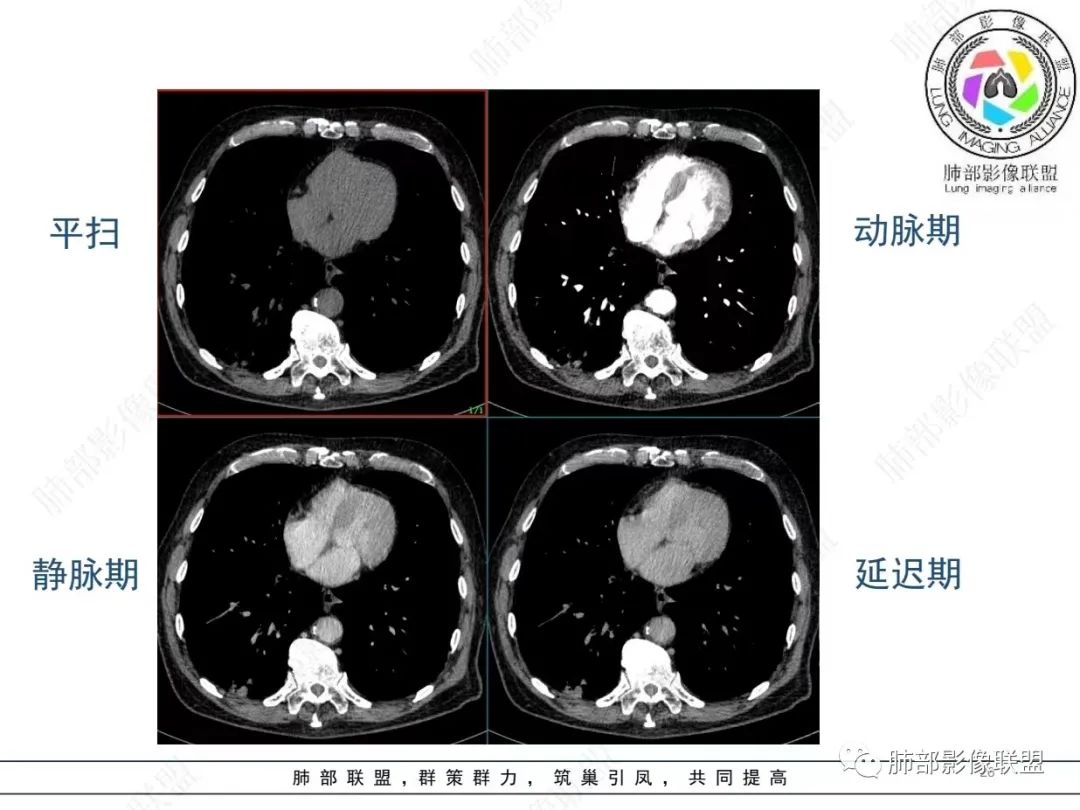 影像PPT - 【病例】胸膜下的“山丘”—肺大细胞神经内分泌癌1例CT-26 影像PPT - 【病例】胸膜下的“山丘”—肺大细胞神经内分泌癌1例CT-26
