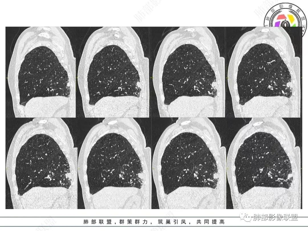 影像PPT - 【病例】胸膜下的“山丘”—肺大细胞神经内分泌癌1例CT-29 影像PPT - 【病例】胸膜下的“山丘”—肺大细胞神经内分泌癌1例CT-29