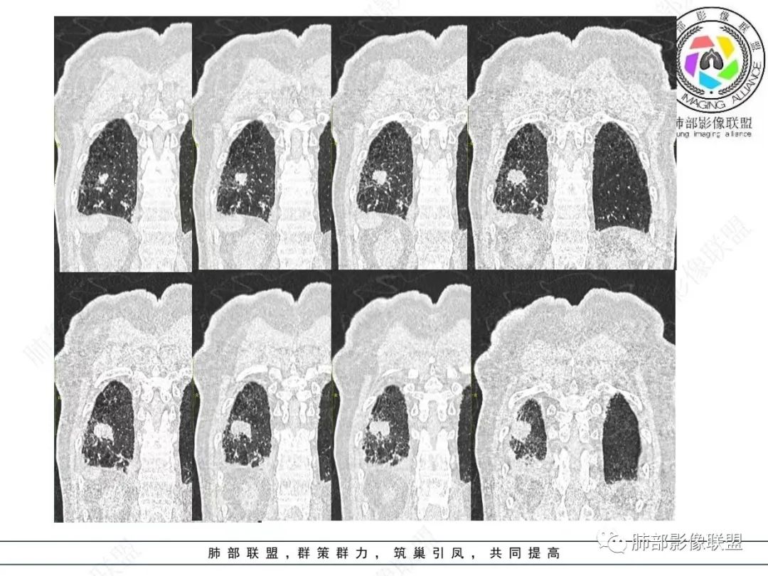 影像PPT - 【病例】胸膜下的“山丘”—肺大细胞神经内分泌癌1例CT-30 影像PPT - 【病例】胸膜下的“山丘”—肺大细胞神经内分泌癌1例CT-30