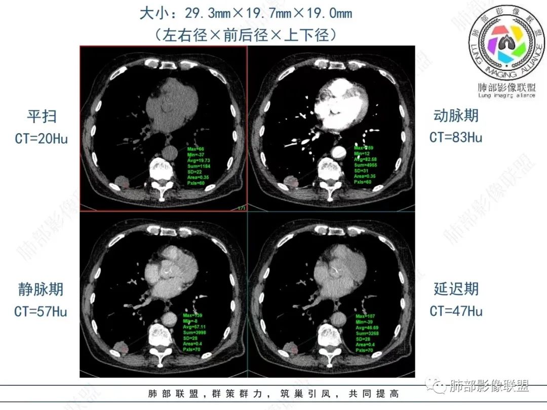 影像PPT - 【病例】胸膜下的“山丘”—肺大细胞神经内分泌癌1例CT-28 影像PPT - 【病例】胸膜下的“山丘”—肺大细胞神经内分泌癌1例CT-28