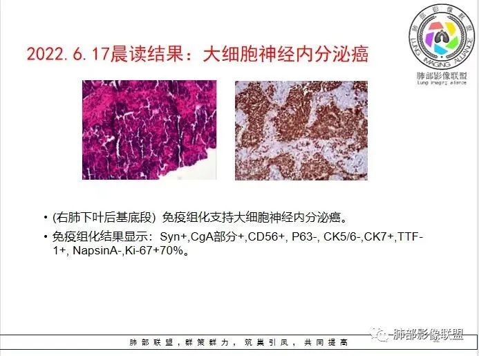 影像PPT - 【病例】胸膜下的“山丘”—肺大细胞神经内分泌癌1例CT-39 影像PPT - 【病例】胸膜下的“山丘”—肺大细胞神经内分泌癌1例CT-39